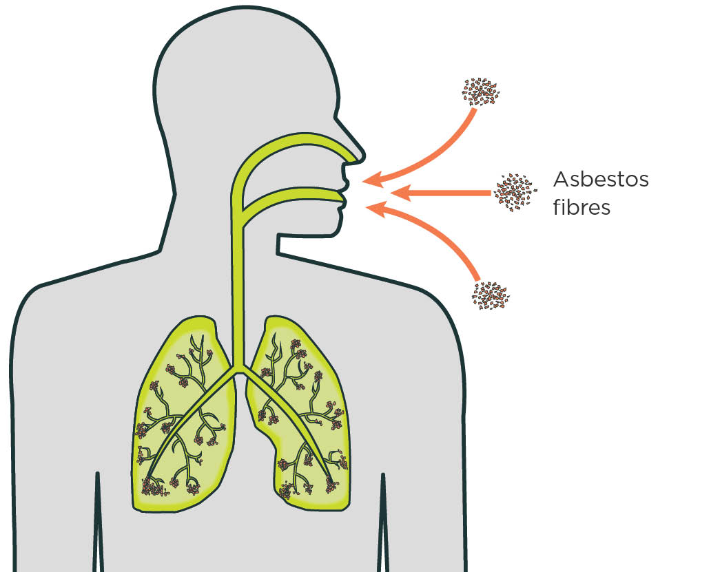 [image] Asbestos fibres can be breathed into lungs